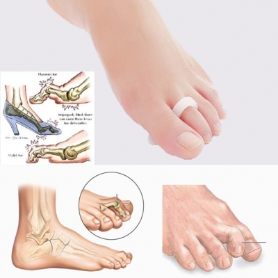 2 Silikon Hallux Valgus Zehenspreizer Krähenzeh - 2